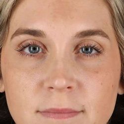 Cosmetic Injectables Before & After Patient #5007