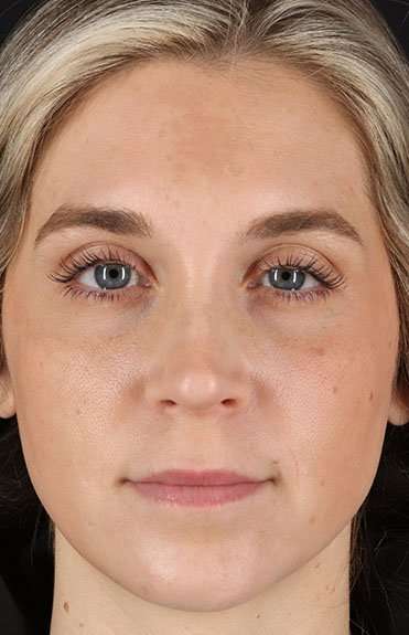 Cosmetic Injectables Before & After Patient #5007