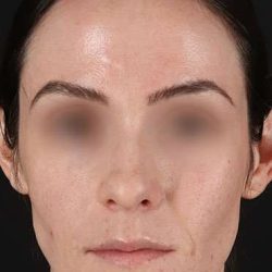 Cosmetic Injectables Before & After Patient #5016