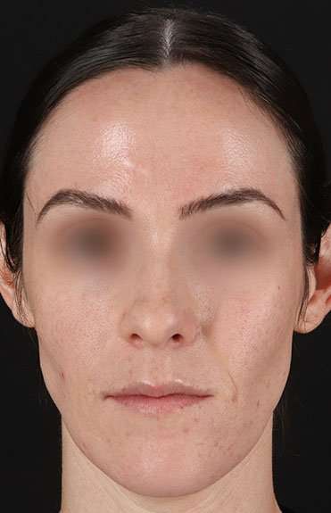 Cosmetic Injectables Before & After Patient #5016