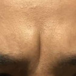 Cosmetic Injectables Before & After Patient #5019