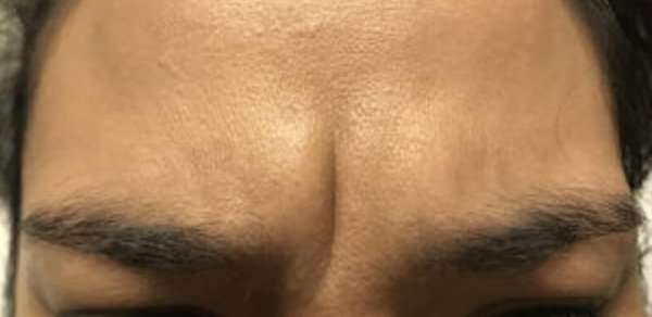 Cosmetic Injectables Before & After Patient #5019