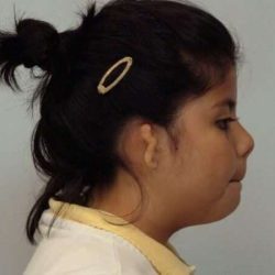Ear Reconstruction / Microtia Before & After Patient #5031