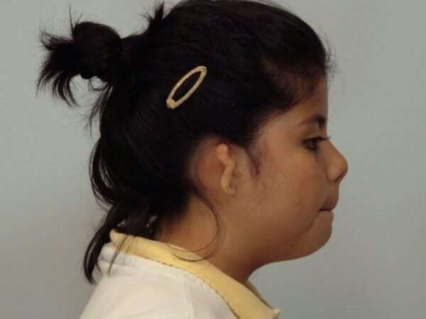 Ear Reconstruction / Microtia Before & After Patient #5031