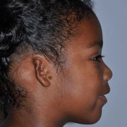 Ear Reconstruction / Microtia Before & After Patient #5034