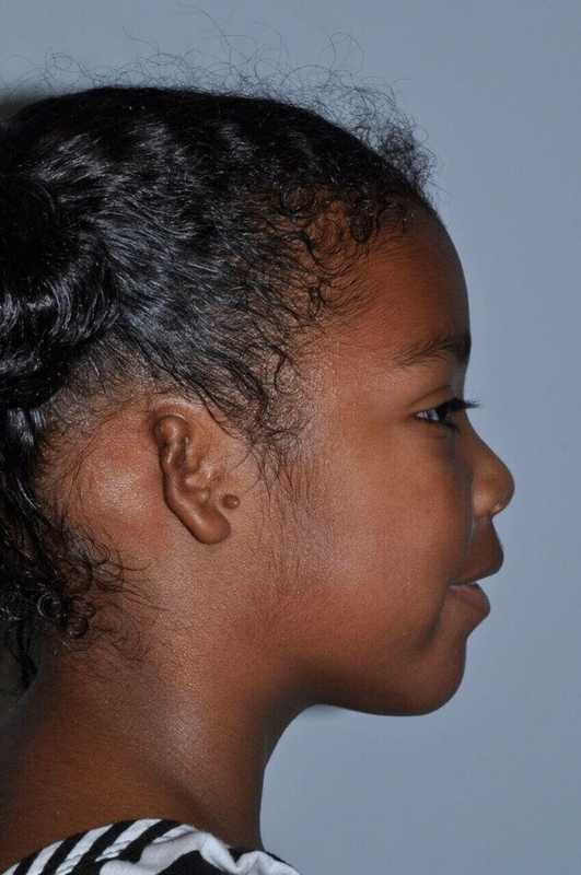 Ear Reconstruction / Microtia Before & After Patient #5034