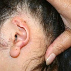 Ear Reconstruction / Microtia Before & After Patient #5037
