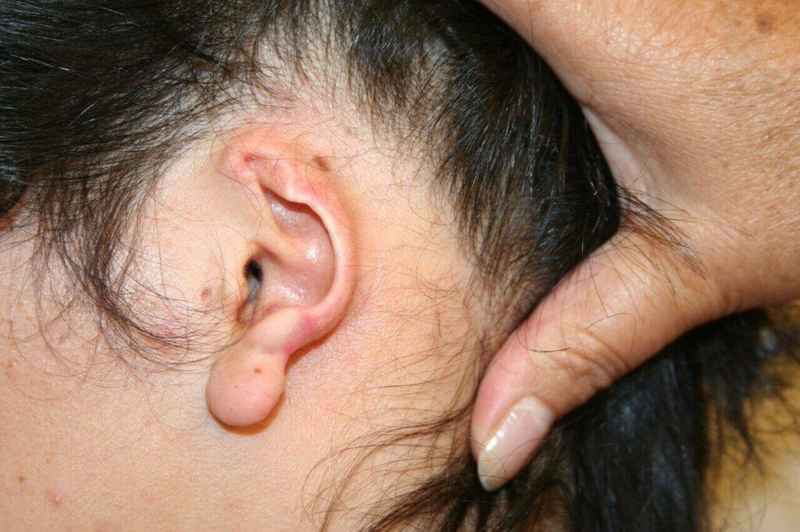 Ear Reconstruction / Microtia Before & After Patient #5037