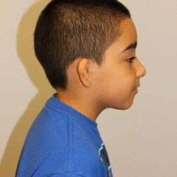 Ear Reconstruction / Microtia Before & After Patient #5040