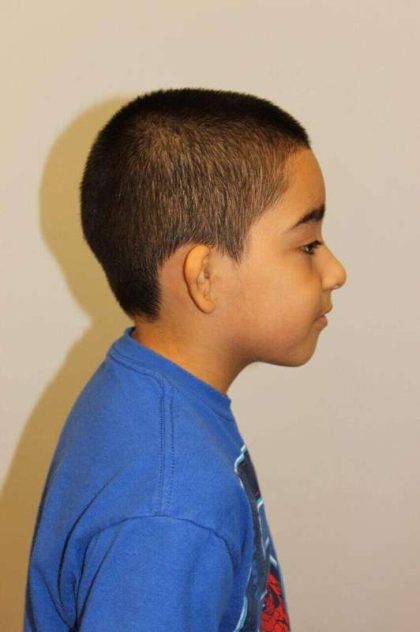 Ear Reconstruction / Microtia Before & After Patient #5040