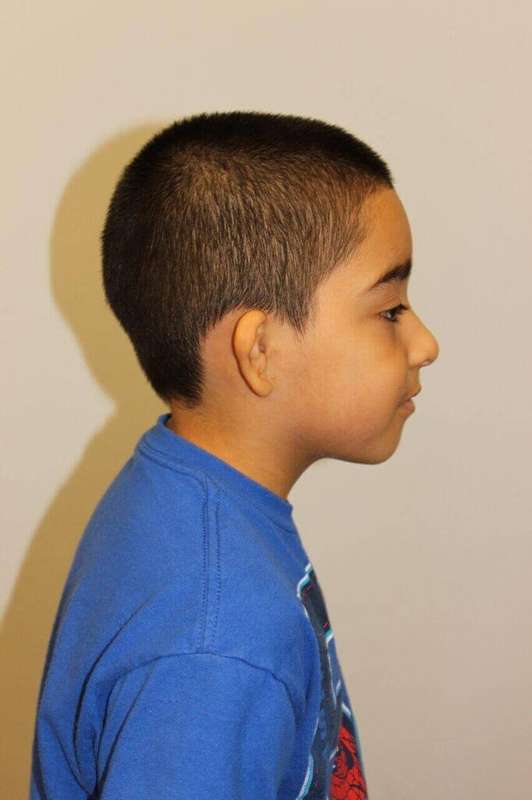 Ear Reconstruction / Microtia Before & After Patient #5040