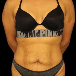 Abdominoplasty (Tummy Tuck) Before & After Patient #601