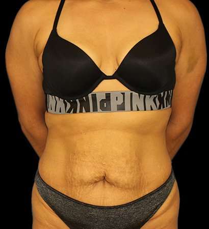 Abdominoplasty (Tummy Tuck) Before & After Patient #601