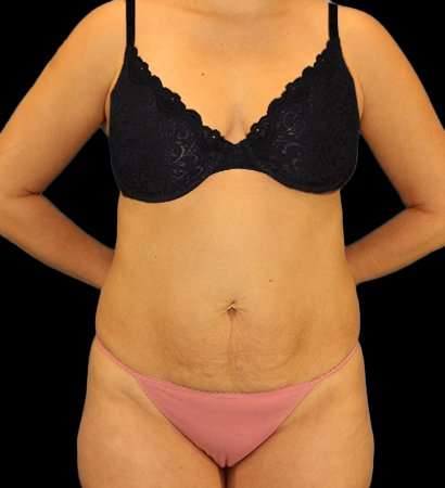 Abdominoplasty (Tummy Tuck) Before & After Patient #1083
