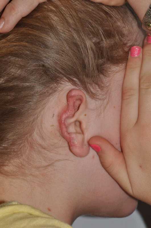 Ear Reconstruction / Microtia Before & After Patient #5045