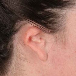 Ear Reconstruction / Microtia Before & After Patient #5048