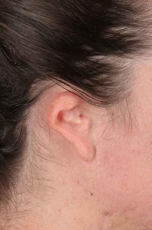 Ear Reconstruction / Microtia Before & After Patient #5048
