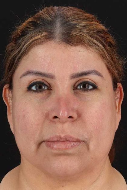 Earlobe Repair Before & After Patient #5064