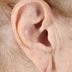 Earlobe Repair Before & After Patient #5067