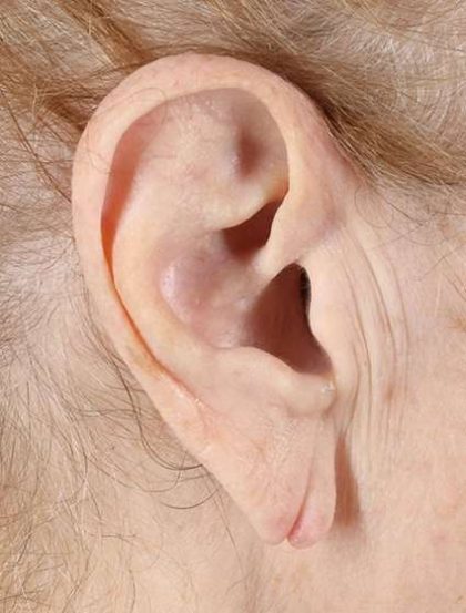 Earlobe Repair Before & After Patient #5067