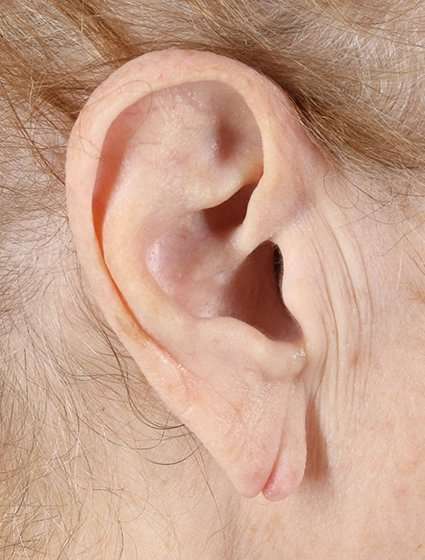 Earlobe Repair Before & After Patient #5067