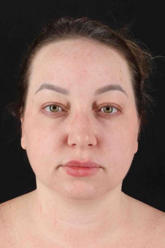 Facelift Before & After Patient #5097