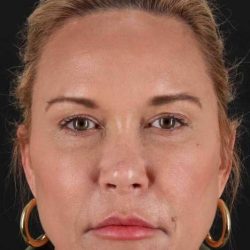Facelift Before & After Patient #5119