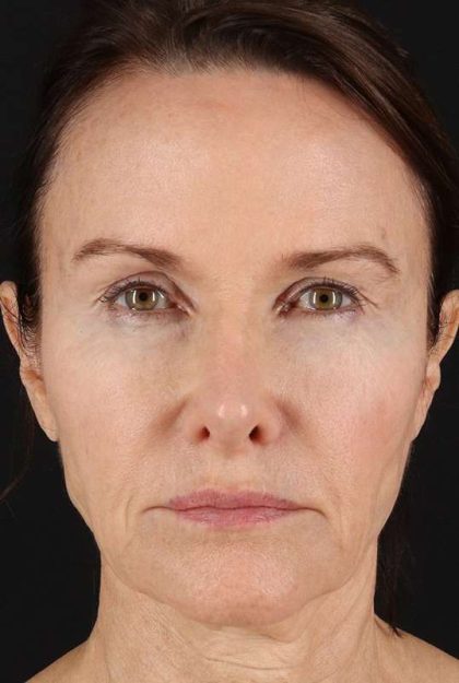 Facelift Before & After Patient #5130