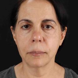 Facelift Before & After Patient #5141