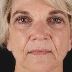 Facelift Before & After Patient #5163