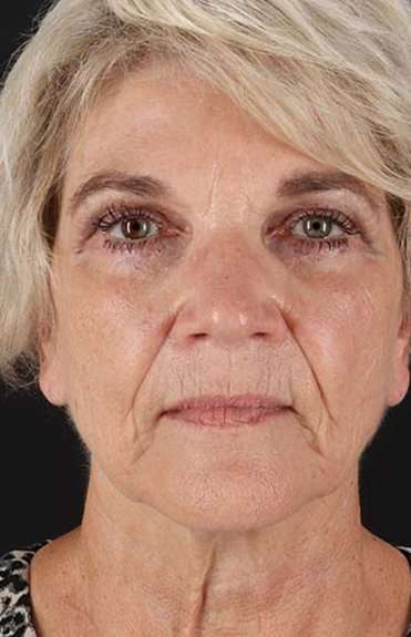 Facelift Before & After Patient #5163