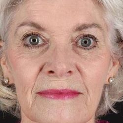 Facelift Before & After Patient #5174