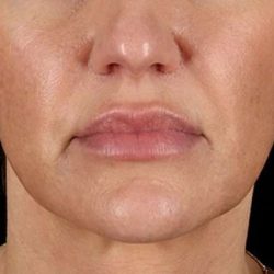Facelift Before & After Patient #5185