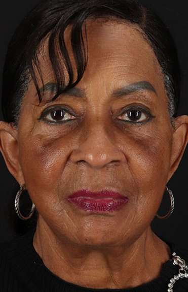 Facelift Before & After Patient #5196