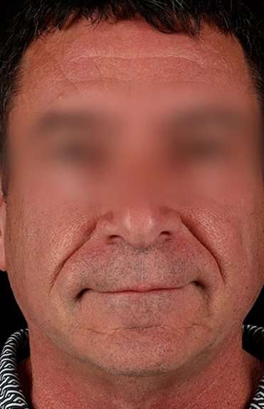 Facelift Before & After Patient #5207