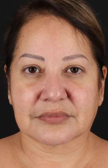 Facelift Before & After Patient #5218