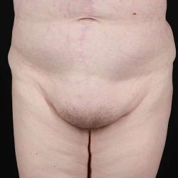 Monsplasty Before & After Patient #1117