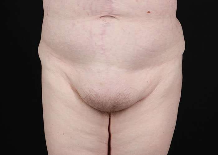 Monsplasty Before & After Patient #1117