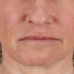 Facelift Before & After Patient #5240