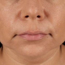 Facelift Before & After Patient #5251