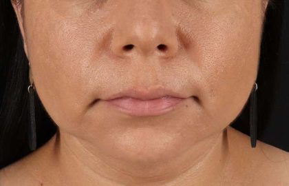 Facelift Before & After Patient #5251