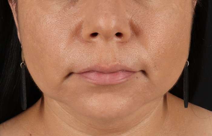 Facelift Before & After Patient #5251