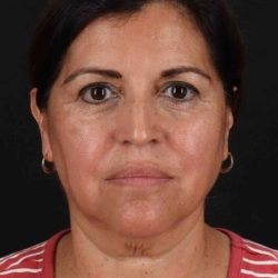 Facelift Before & After Patient #5284
