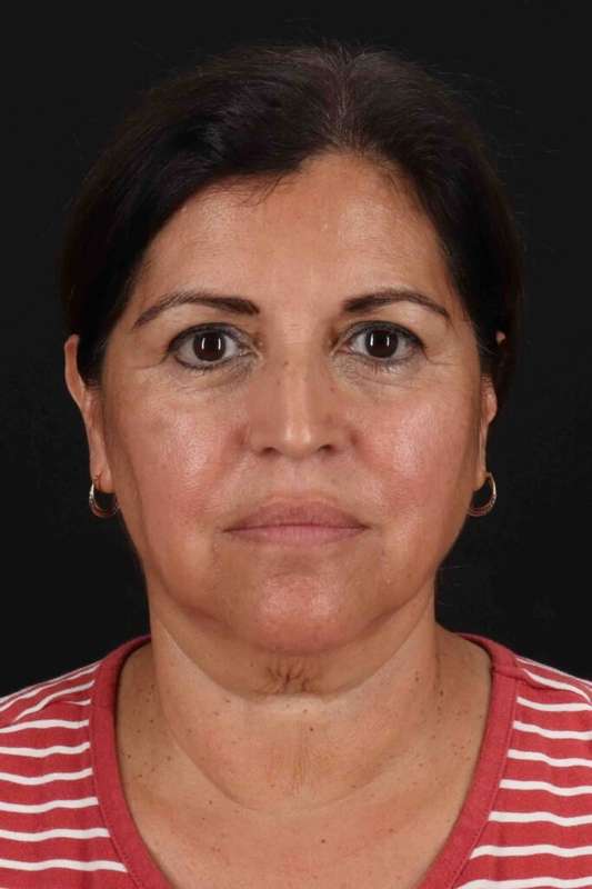 Facelift Before & After Patient #5284