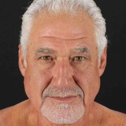 Facelift Before & After Patient #5306