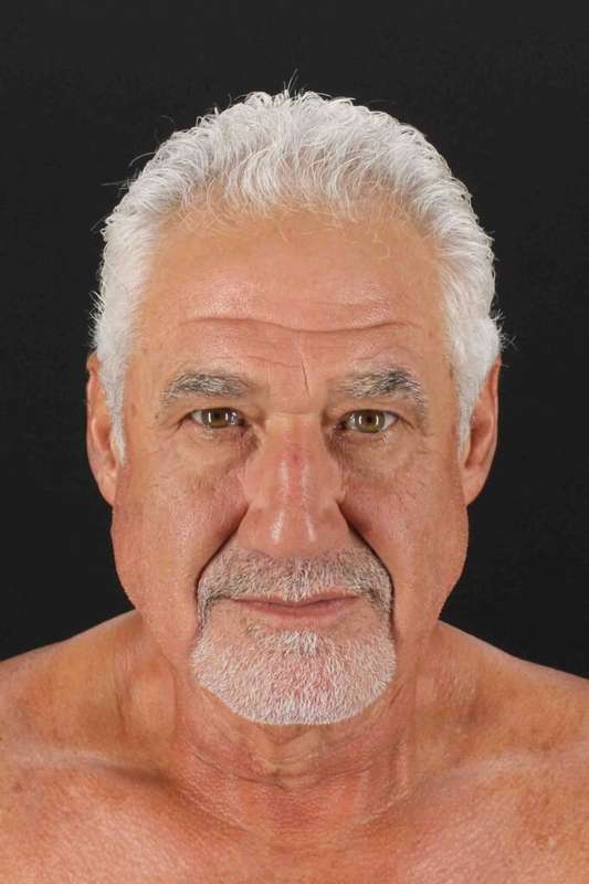 Facelift Before & After Patient #5306