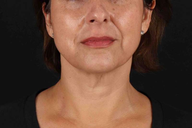 Facelift Before & After Patient #5315