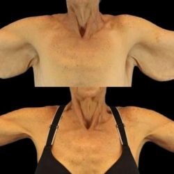 Brachioplasty (Arm Lift) Before & After Patient #1121