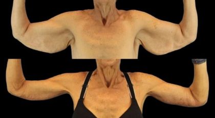 Brachioplasty (Arm Lift) Before & After Patient #1121