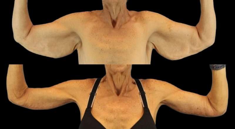 Brachioplasty (Arm Lift) Before & After Patient #1121